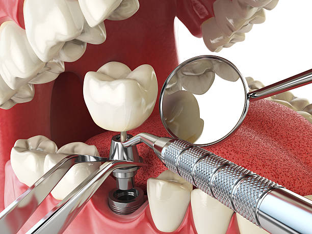 Best Emergency Tooth Extraction in Dickinson, ND